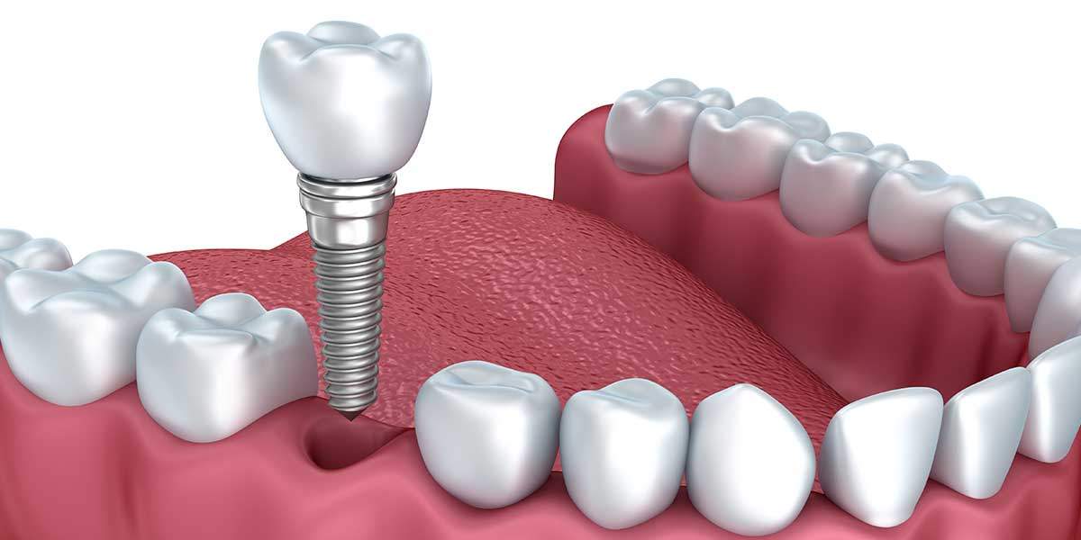 dental implants in eatons hill